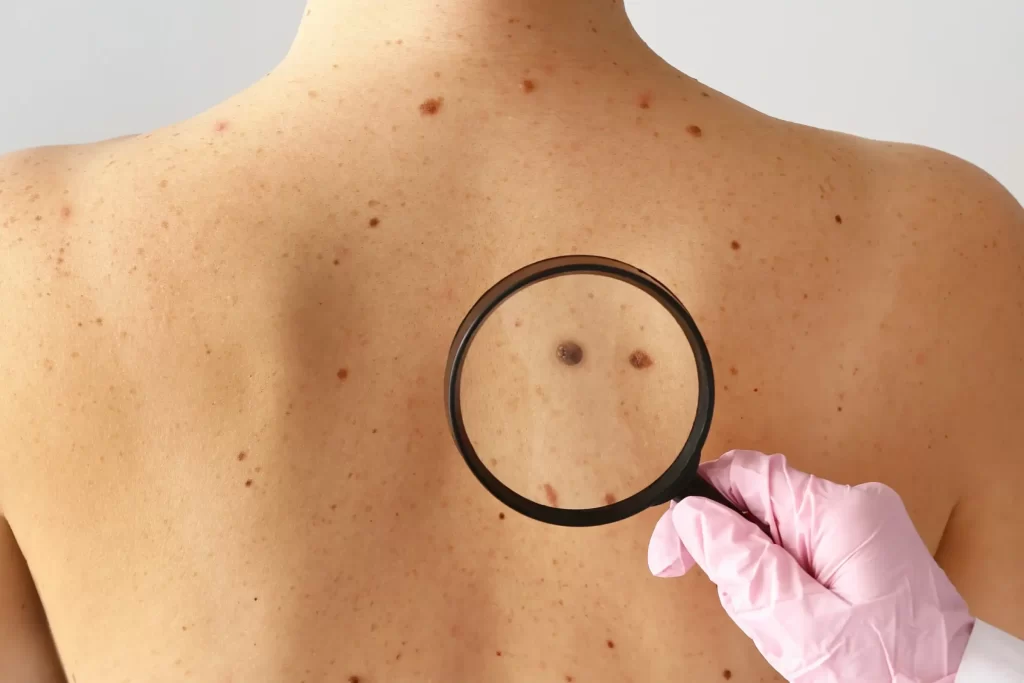 Full body mole mapping template for med spas