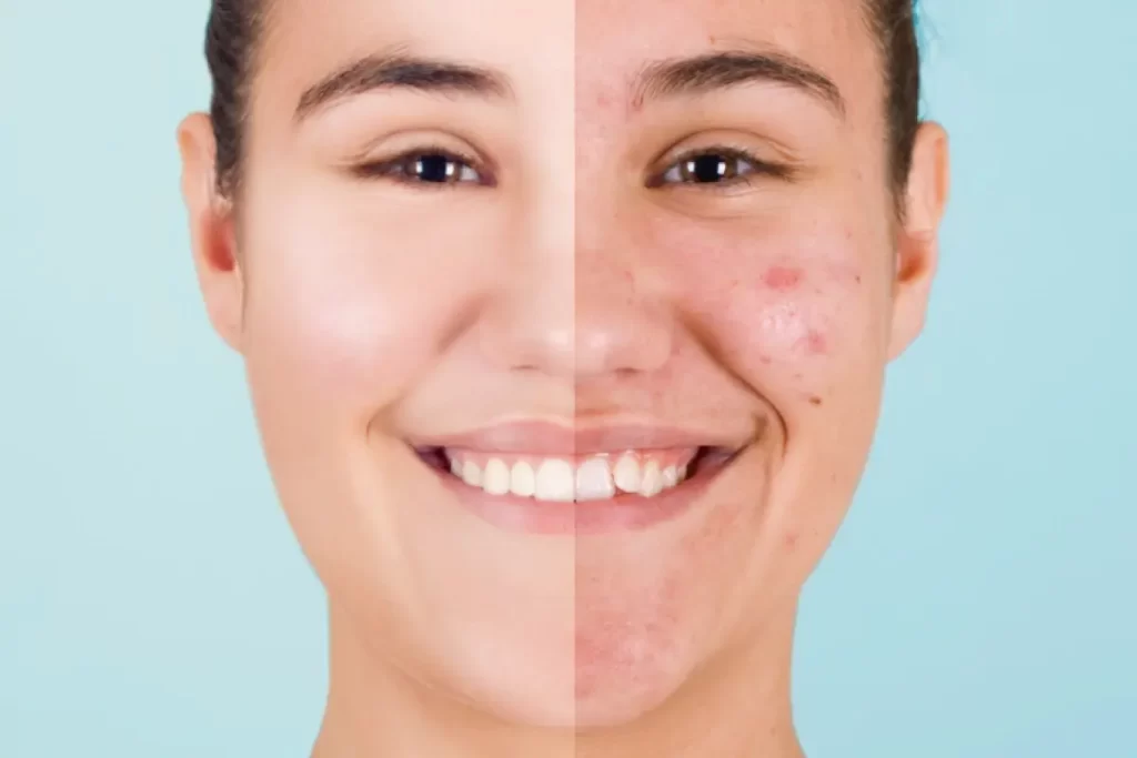 How to streamline acne face mapping: A simple guide + free template